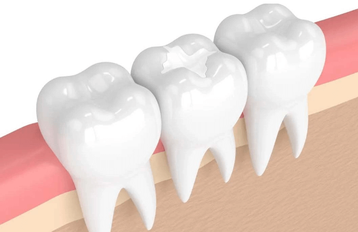 composite fillings