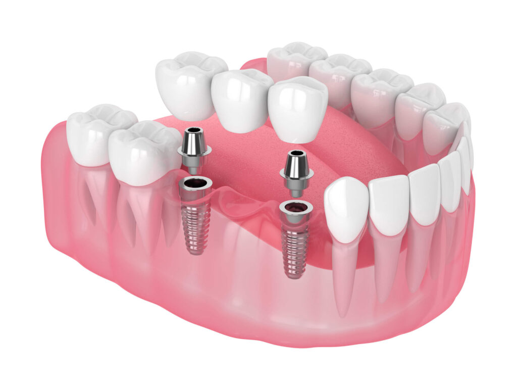 dental bridges