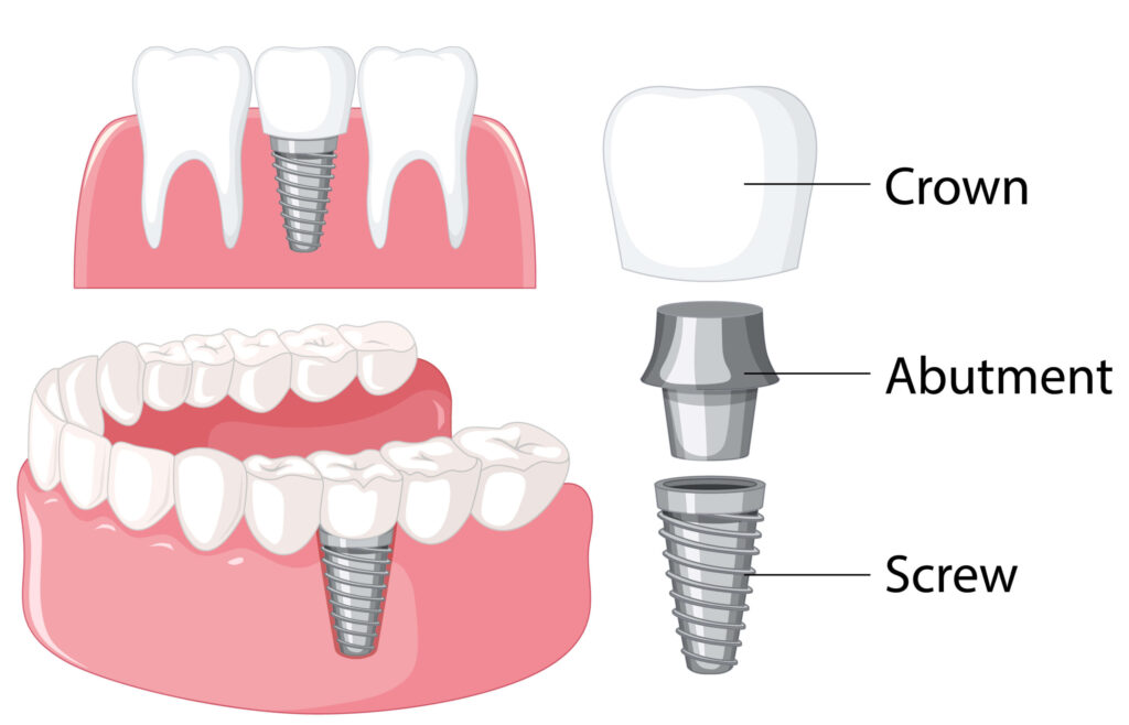 dental implant