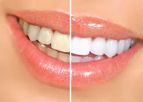teeth cleaning in pimpri chinchwad