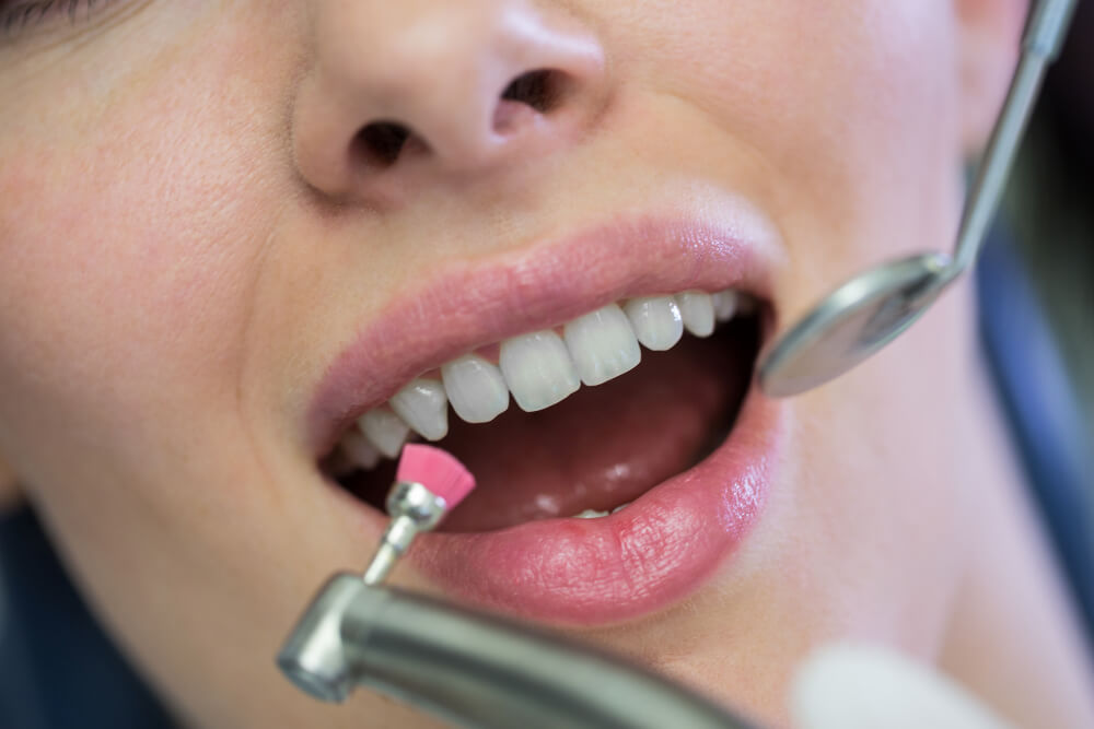 teeth clenaing and polishing