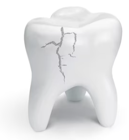 teeth fracture treatment in pcmc, pune