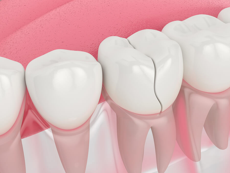 teeth fracture treatment pcmc