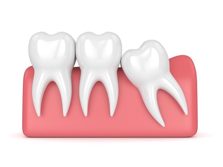 wisdom tooth removal